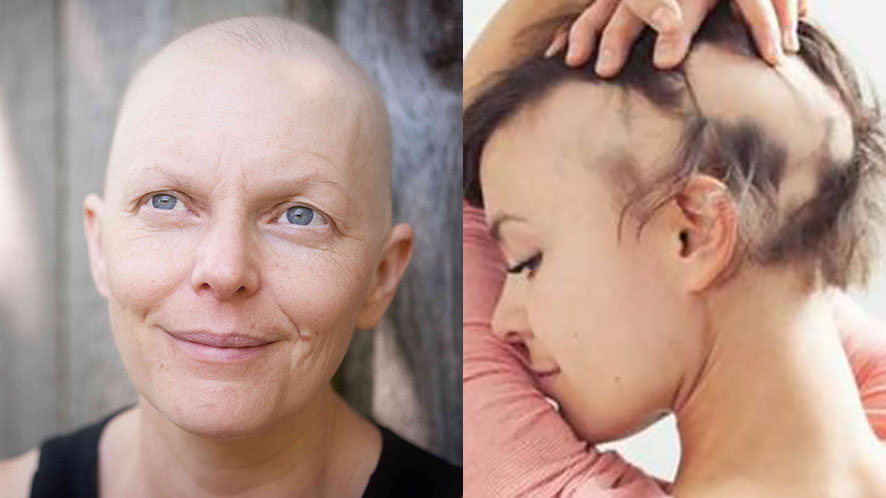 Basic Guide of Cranial Prosthesis aka Medical Wigs (3)