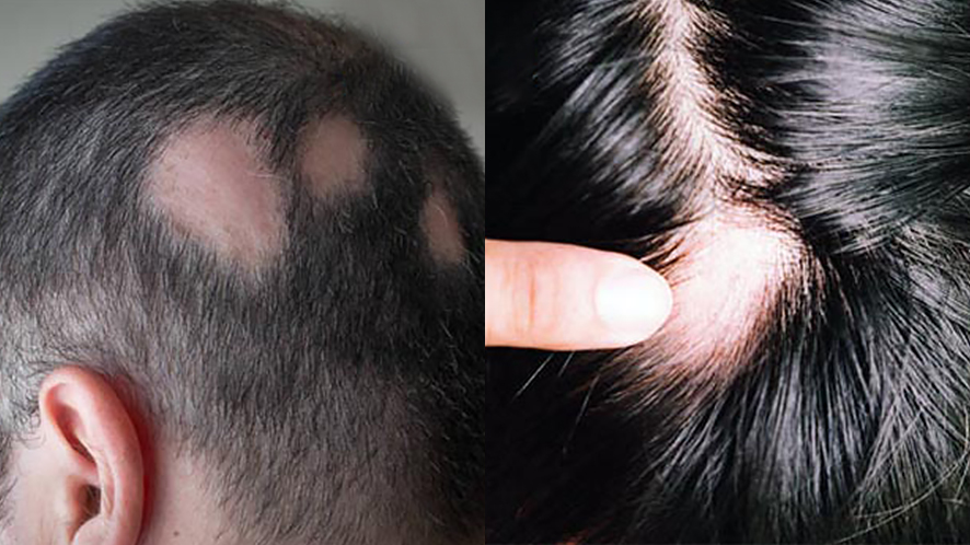 Men Hair Transplant (17)
