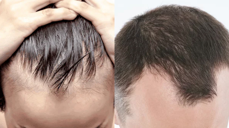 Men Hair Transplant (18)