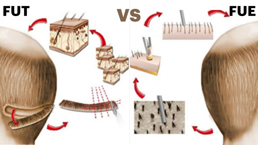 Men Hair Transplant (19)