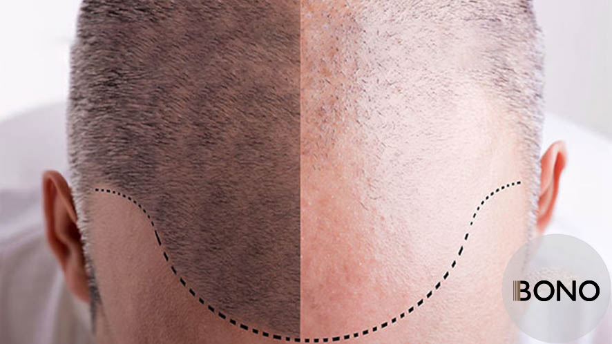Men Hair Transplant (5)