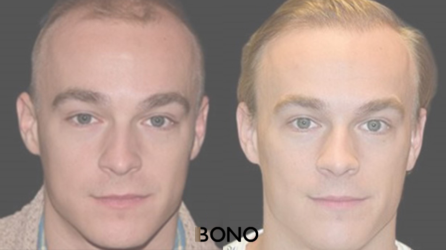 Men Hair Transplant (7)