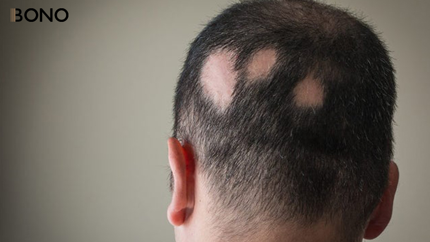 10 causes of hair losses.edited.edited (6)