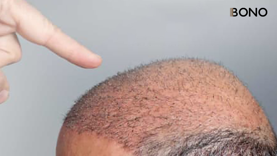 10 causes of hair losses.edited.edited (8)