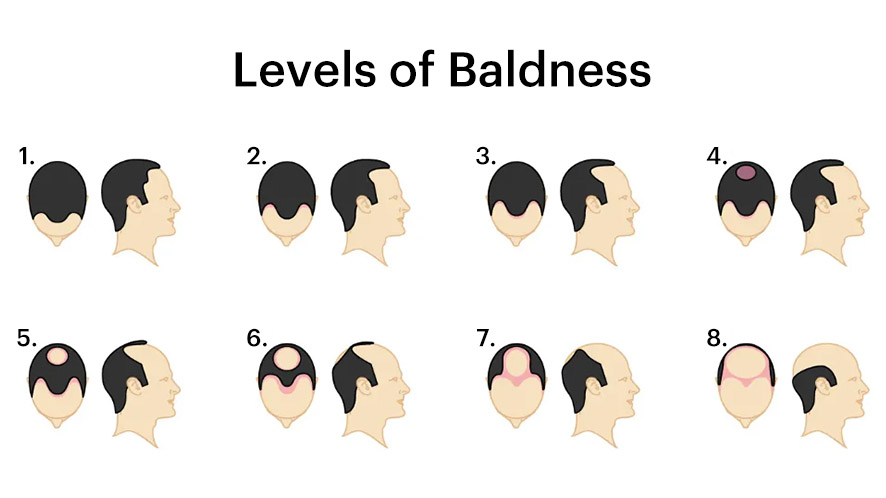 Wondering How to Solve Types of Baldness (4)