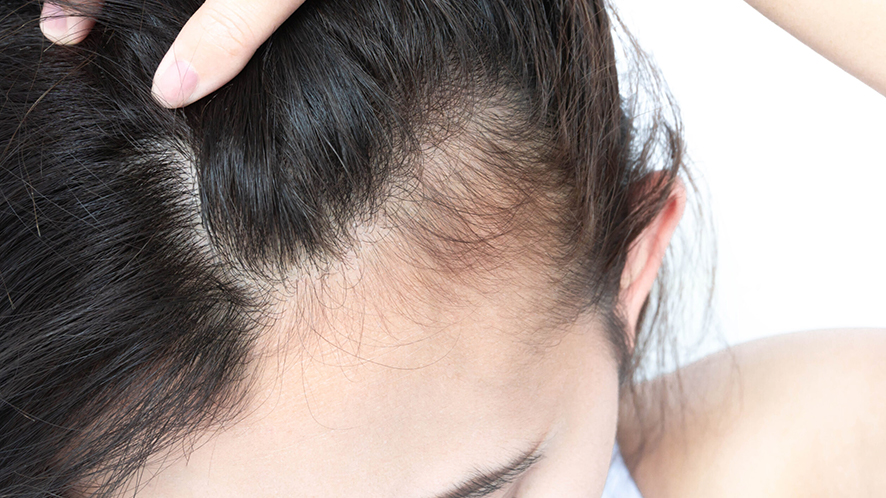 Wondering How to Solve Types of Baldness (5)