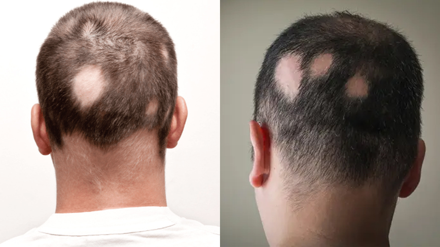 Wondering How to Solve Types of Baldness (6)