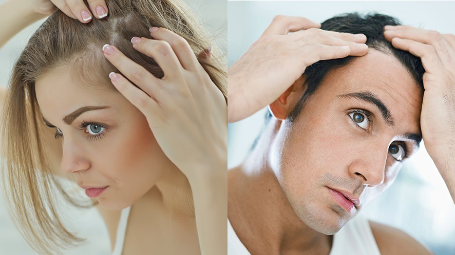Wondering How to Solve Types of Baldness (7)