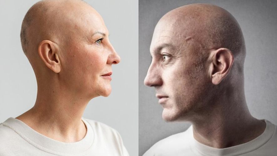 Wondering How to Solve Types of Baldness (8)