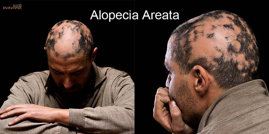 What is Alopecia and Alopecia Treatment (10)