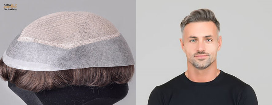 What is Alopecia and Alopecia Treatment (21)