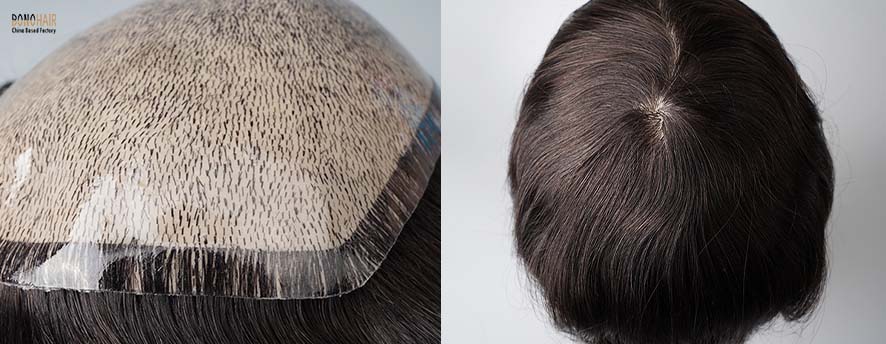 What is Alopecia and Alopecia Treatment (23)