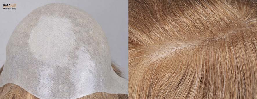 What is Alopecia and Alopecia Treatment (24)