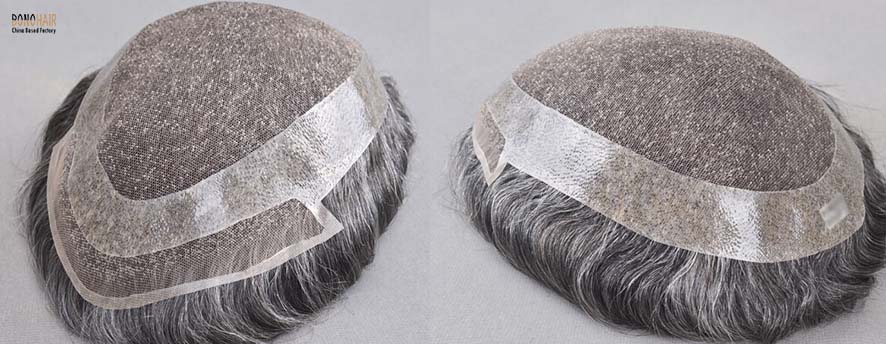 What is Alopecia and Alopecia Treatment (27)