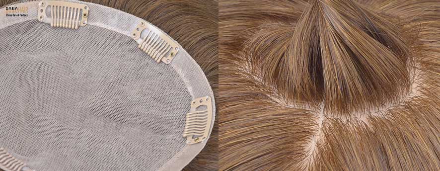What is Alopecia and Alopecia Treatment (3)