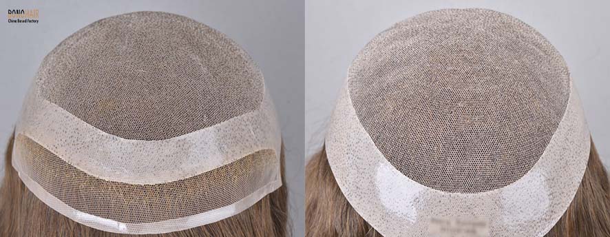 What is Alopecia and Alopecia Treatment (5)