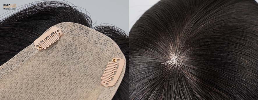 What is Alopecia and Alopecia Treatment (7)